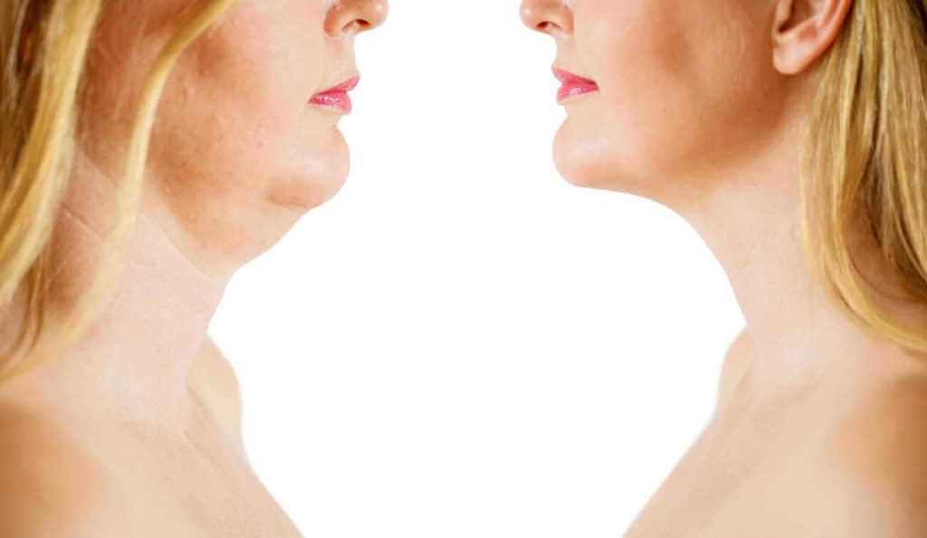 Double Chin treatment Weymouth before and after results