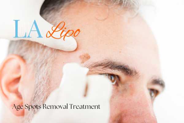What Are the Most Effective Treatments for Age Spots Weymouth?