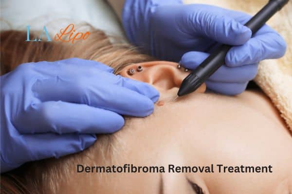 Dermatofibroma Removal Treatment Weymouth