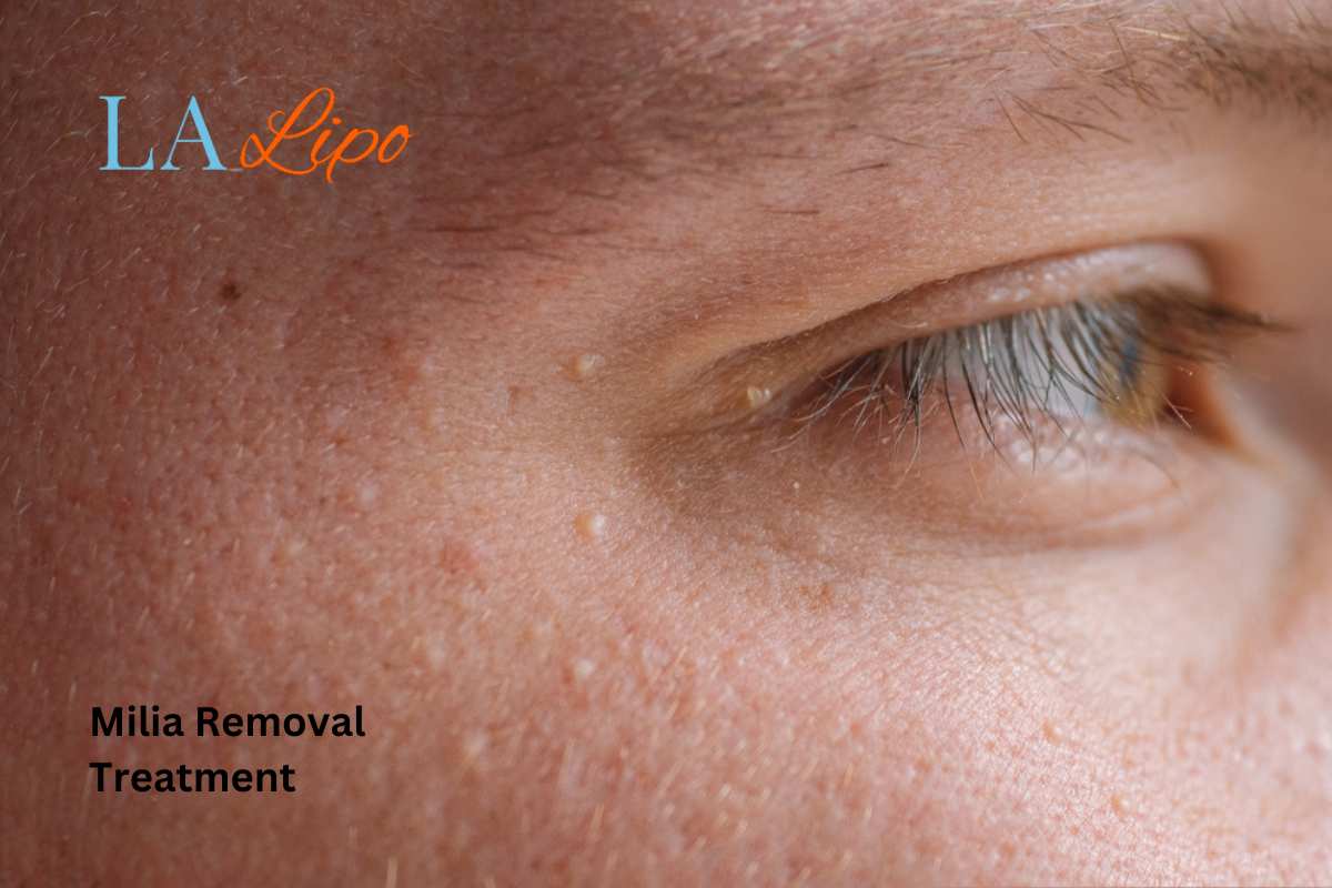Cryopen Milia Removal: Is It the Easiest and Safest Option Weymouth?