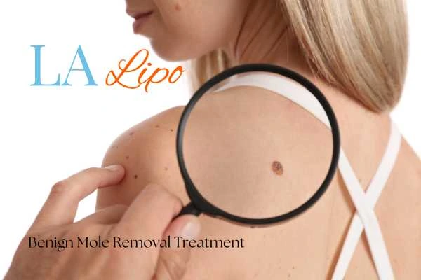 Why getting moles removed Weymouth can boost your confidence!