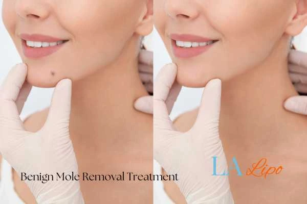 Woman's before and after results of being moles removal treatment Weymouth