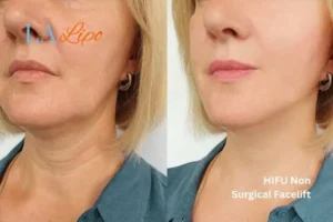 hi-fu for wrinkles Weymouth before and after results