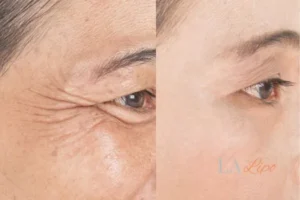 Before and after results of woman - HI-fu wrinkles reduction treatment Weymouth