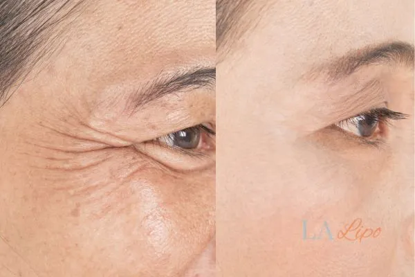 Before and after results of woman - HI-fu wrinkles reduction treatment Weymouth