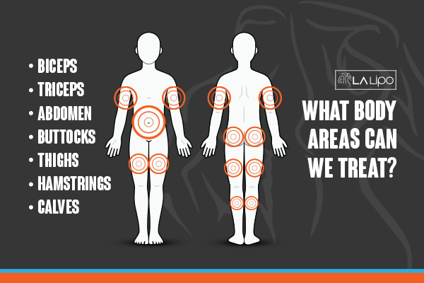 Graphic to show areas you can have LA-EMS Body Sculpting Weymouth treatment.