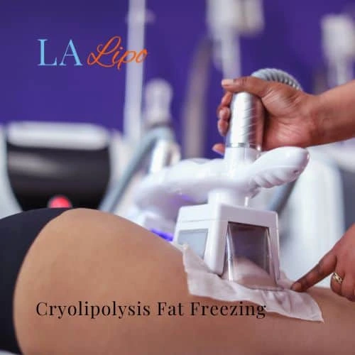 fat freezing - Cryolipolysis Weymouth