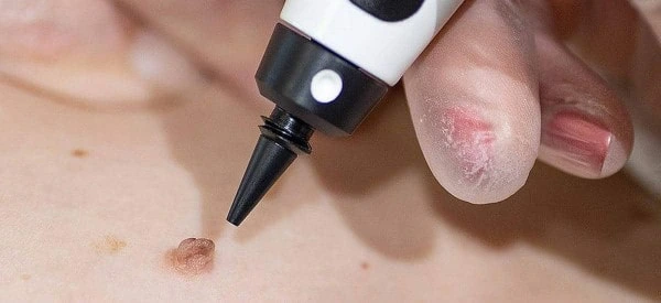 skin tag removal using cryopen Weymouth