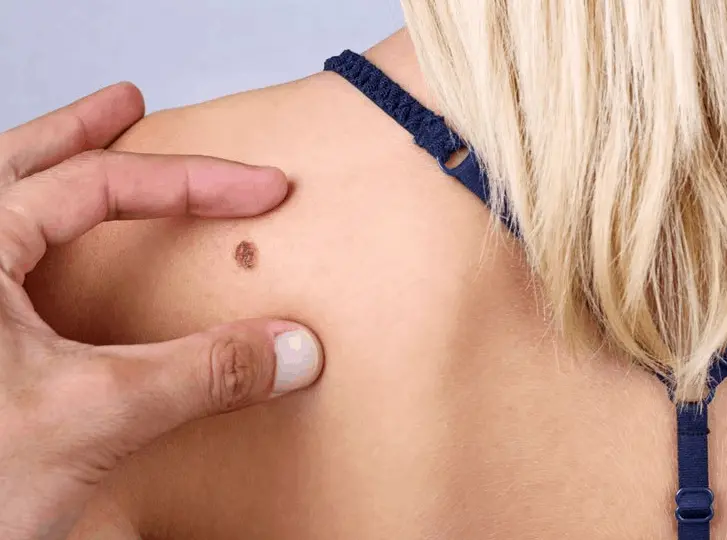 woman having mole removal Weymouth consultation before treatment.