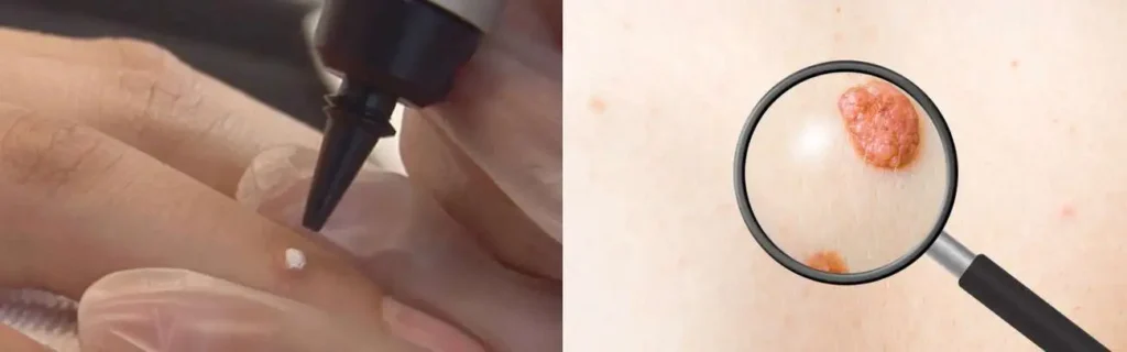 Cryopen for mole removal Weymouth - speak to our team today!