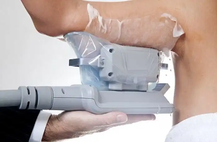 Picture of fat freezing Weymouth on the upper arms.