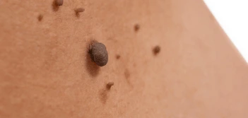 image of a skin tag Weymouth