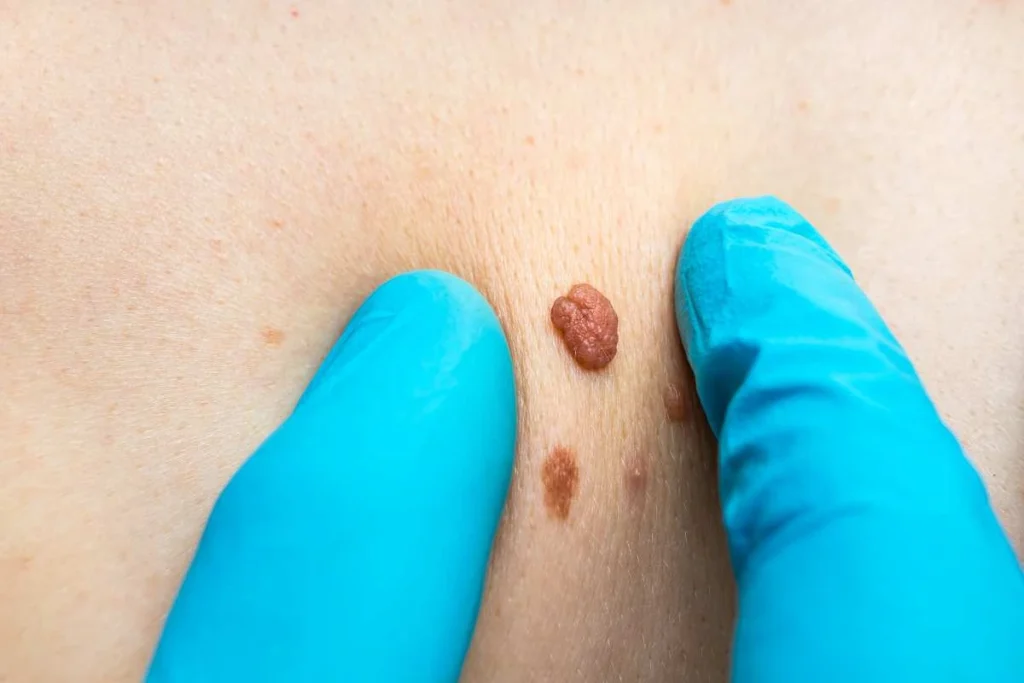 Consultant examining a skin tag Weymouth