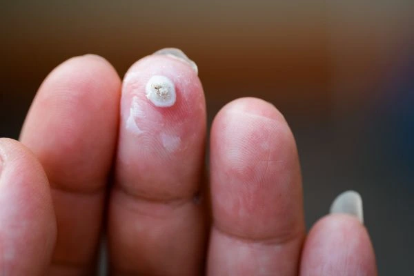wart on person finger - cryotherapy to treat from LA LIPO Weymouth