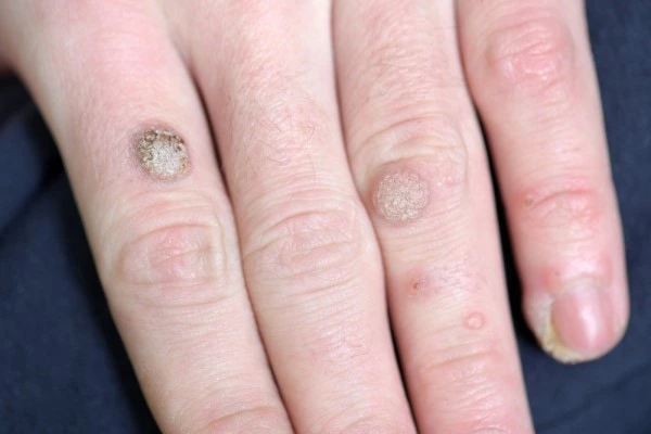 photo of warts on person hand - see wart removal Weymouth from LA LIPO