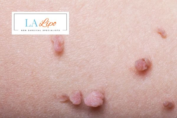 Does cryopen skin tag removal Weymouth hurt? Find out now call our team today!