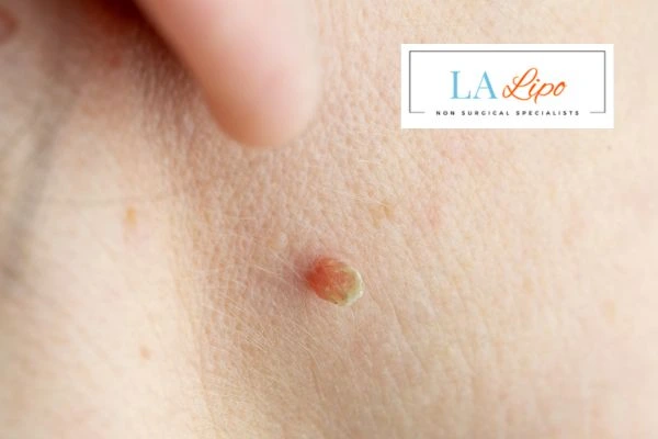 Book skin tag removal Weymouth today speak to our team now!