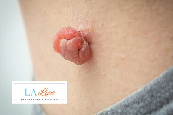 Interested in skin tag removal Weymouth? Concerned about the pain? Find out more today!