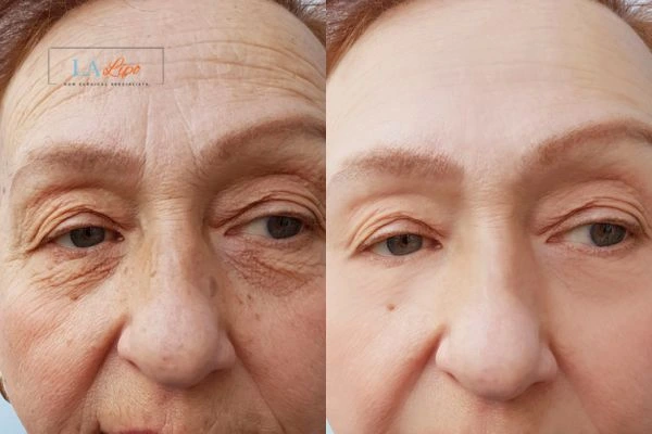 The powerful benefits of Morpheus8 Treatment Weymouth - Call Our team today!