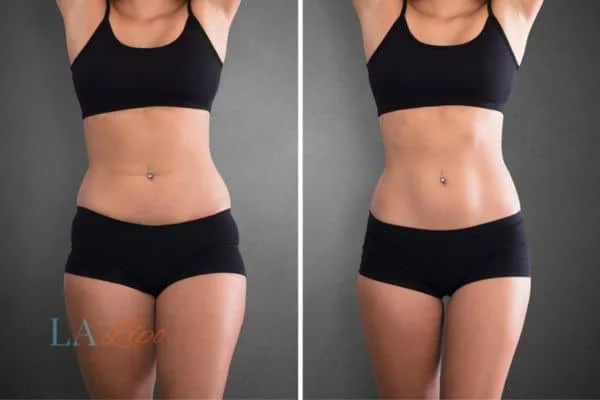 before and after results of non-surgical treatment to help a woman's body image and mental health Weymouth