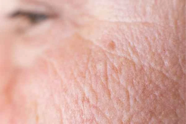 close up picture of a woman's face showing an age spot Weymouth