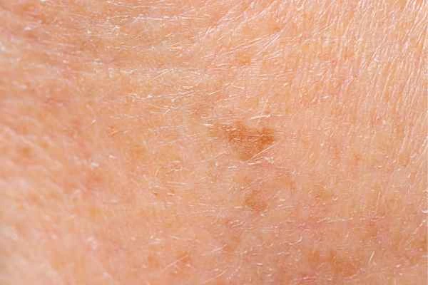 close up picture of age spots Weymouth