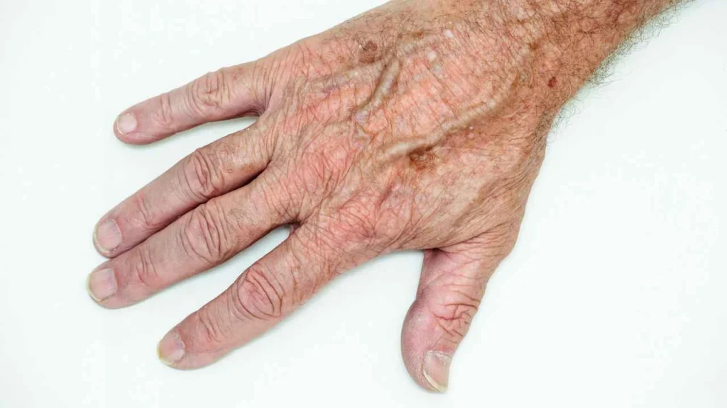 Male hand showing age spot Weymouth