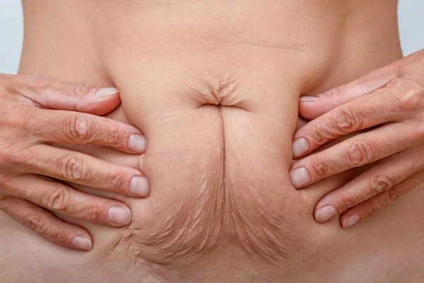 Image of a woman's stomach with loose skin - example of skin tightening Weymouth options